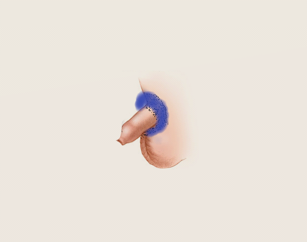 Denne figur viser dig hvor omkring penis tryllecremen skal påsmøres